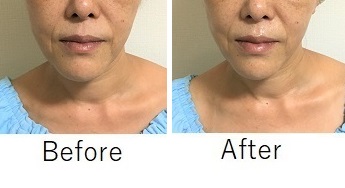 ビフォー・アフター鼻下